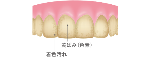 沈着した色素（原因：加齢・全身疾患など）、着色汚れ（原因：コーヒー、お茶、喫煙などの嗜好品）