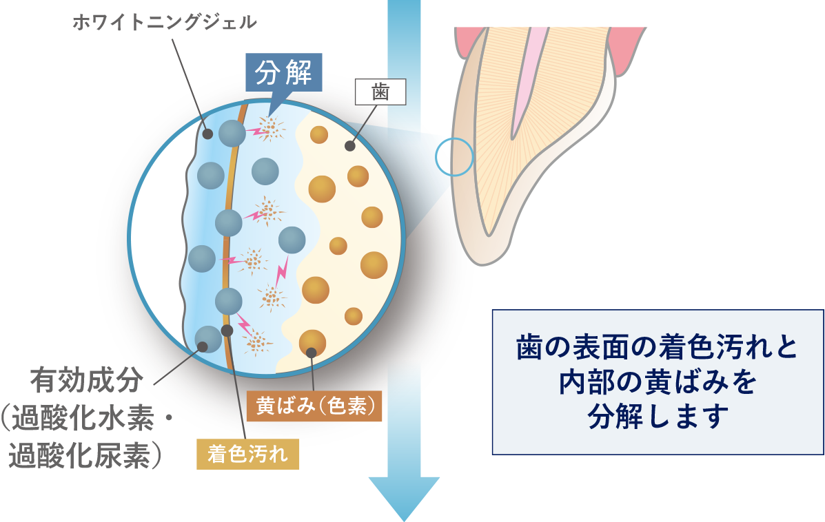 過酸化水素または過酸化尿素、歯の表面の着色汚れと内側の沈着した色素を分解します