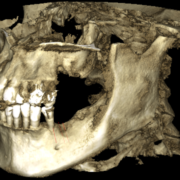 顎骨の3D表示画像